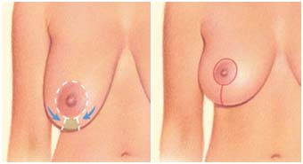 Breast lift surgery in India